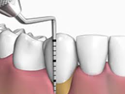 Periodoncia (Encías y Limpiezas Dentales):
