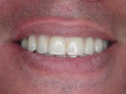 Prótese Fixa Parafusada ou Cimentada