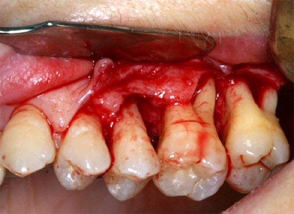Cirugías Periodontales